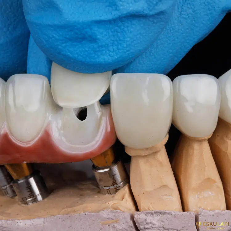 Removable prosthesis on implants (conditionally removable)